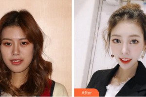 阜陽(yáng)愛齒口腔門診部李文超整形價(jià)格表附隱形托槽矯正案例展示