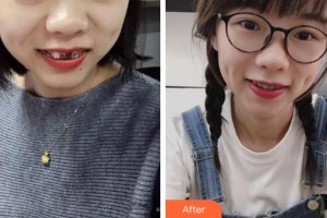 阜陽(yáng)愛齒口腔門診部李云安整形價(jià)格表附金屬托槽矯正案例展示