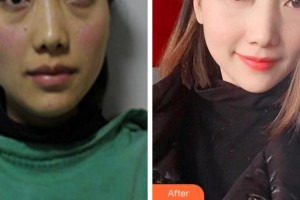 阜陽(yáng)七院愛爾眼科醫(yī)院姚艷芳整形價(jià)格表附激光去眼袋案例展示