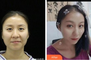 阜陽(yáng)七院愛爾眼科醫(yī)院馬頌章整形價(jià)格表附眼部修復(fù)案例展示