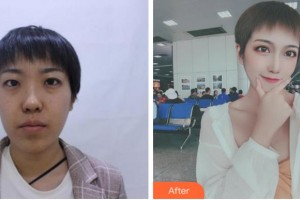 阜陽七院愛爾眼科醫(yī)院孫翠玲整形價(jià)格表附眼部綜合案例展示