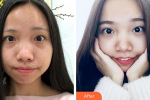 阜陽七院愛爾眼科醫(yī)院儲彪整形價(jià)格表附激光去眼袋案例展示