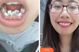 阜陽愛齒口腔門診部張士彬整形價(jià)格表附金屬托槽矯正案例展示