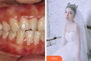 阜陽愛齒口腔門診部楊靜靜整形價(jià)格表附牙齒隱形矯正案例展示