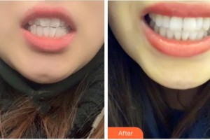 阜陽貝德口腔門診部張永康整形價(jià)格表附隱形托槽矯正案例展示