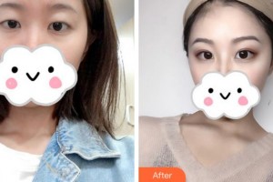 阜陽納美星范醫(yī)療美容門診部高陽整形價(jià)格表附切開雙眼皮案例展示