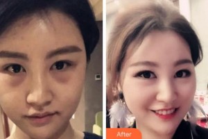 阜陽澤明眼科醫(yī)院鹿秀蘭整形價(jià)格表附內(nèi)切祛眼袋案例展示