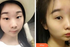 阜陽澤明眼科醫(yī)院陳曉艷整形價(jià)格表附切開雙眼皮案例展示