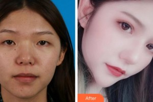 阜陽澤明眼科醫(yī)院張桂山整形價(jià)格表附切開雙眼皮案例展示