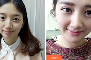 阜陽福田眼科醫(yī)院顧永昊整形價(jià)格表附切開雙眼皮案例展示