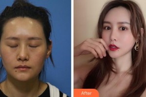 阜陽福田眼科醫(yī)院丁健整形價(jià)格表附埋線雙眼皮案例展示