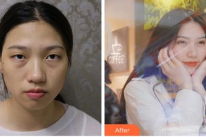 阜陽福田眼科醫(yī)院王福田整形價(jià)格表附切開雙眼皮案例展示