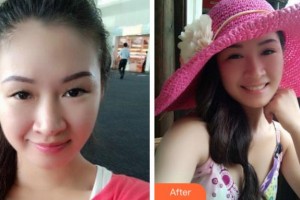 阜陽中西醫(yī)結(jié)合眼耳鼻喉科醫(yī)院汝子杰整形價(jià)格表附切開雙眼皮案例展示