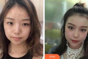 阜陽華山醫(yī)院眼科程光輝整形價(jià)格表附開內(nèi)眼角案例展示