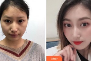 阜陽市第七人民醫(yī)院眼科高明煜整形價(jià)格表附開內(nèi)眼角案例展示