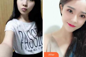 阜陽市第五人民醫(yī)院整形美容科袁道毅整形價(jià)格表附眼部綜合案例展示