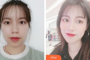 宿州陽光醫(yī)療美容醫(yī)院蔣相峰整形價(jià)格表附眼部整形案例展示