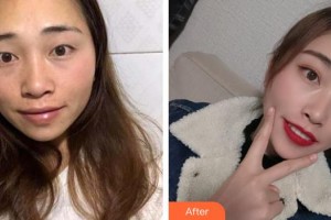 宿州天使醫(yī)療美容門診部曹龍整形價(jià)格表附雙眼皮案例展示