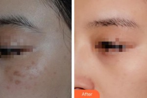 宿州陽光醫(yī)療美容醫(yī)院王雙雙整形價(jià)格表附激光祛痣案例展示