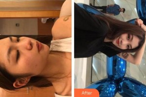 宿州康麗醫(yī)療美容門診部李夢義整形價(jià)格表附光子嫩膚案例展示