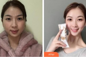 宿州天使醫(yī)療美容門診部谷曉紅整形價(jià)格表附激光祛斑案例展示