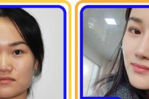 宿州美萊醫(yī)療美容醫(yī)院李培德整形價(jià)格表附鼻部整形案例展示