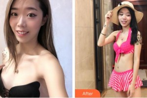 宿州康麗醫(yī)療美容門診部胡朝暉整形價(jià)格表附自體脂肪隆胸案例展示