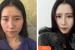 宿州漢密爾頓醫(yī)學(xué)美容醫(yī)院方明松整形價(jià)格表附鼻修復(fù)案例展示