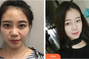 宿州漢密爾頓醫(yī)學(xué)美容醫(yī)院樸尚恩整形價(jià)格表附隆鼻案例展示