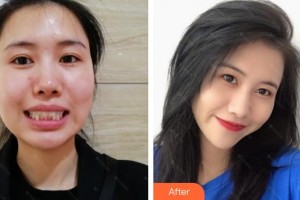 宿州愛牙口腔醫(yī)院張偉彬整形價(jià)格表附牙齒隱形矯正案例展示