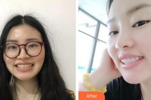 宿州醫(yī)美佳人醫(yī)療美容醫(yī)院徐文龍整形價(jià)格表附口腔矯正案例展示