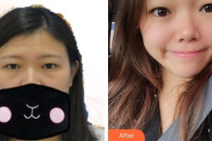 宿州市立醫(yī)院眼科黃超整形價(jià)格表附去眼袋案例展示