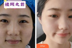 六安市人民醫(yī)院醫(yī)學(xué)美容中心邢紅整形價(jià)格表附祛斑案例展示