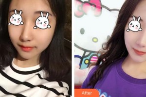 六安伊而美醫(yī)療整形美容醫(yī)院水慶亮整形價(jià)格表附光子嫩膚案例展示