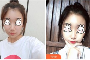 六安嘉秀醫(yī)療美容門診部翁上喬整形價(jià)格表附光子嫩膚案例展示