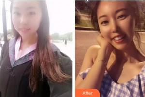 六安菲凡整形醫(yī)院程啟整形價格表附牙齒陶瓷矯正案例展示