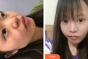 六安市第二人民醫(yī)院燒傷整形科丁美軍整形價格表附祛疤案例展示