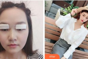 六安市第六人民醫(yī)院眼科佘傳應整形價格表附眼部案例展示