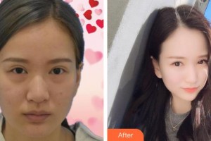 六安瑞視眼科醫(yī)院陳朝玉整形價格表附祛眼袋案例展示