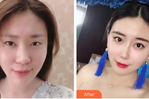 亳州締美醫(yī)療整形美容診所李為整形價格表附鼻部案例展示