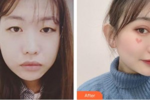 亳州締美醫(yī)療整形美容診所劉衛(wèi)整形價格表附眼部整形案例展示