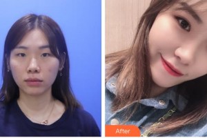 亳州愛爾眼科醫(yī)院楊智寬整形價格表附定點雙眼皮案例展示