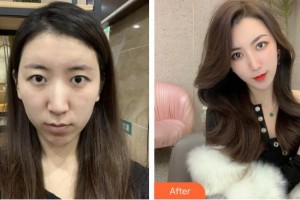 亳州愛爾眼科醫(yī)院褚彪整形價格表附眼部手術案例展示