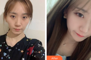 廣州壹加壹美容醫(yī)院項美連整形價格表附顴骨顴弓案例展示