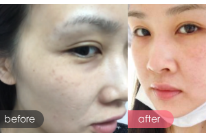 廣州市第十二人民醫(yī)院整形美容科何榮國整形價格表附皮膚微秒案例展示