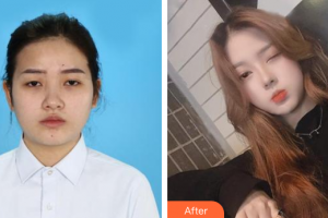 廣州艾美醫(yī)療美容門診部李琳整形價格表附鼻部綜合案例展示