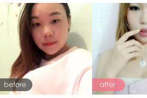 廣州慕美醫(yī)療美容醫(yī)院韓淼整形價(jià)格表附女性私密案例展示