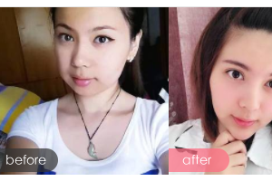 廣州愛來（原阿瑪施）醫(yī)療美容整形醫(yī)院王志農整形價格表附下頜角整形案例展示