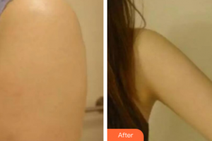 廣州軍美整形醫(yī)院王娜整形價格表附吸脂瘦手臂案例展示