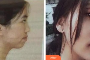 池州伊尚美醫(yī)療美容門診部陸黛咪整形價(jià)格表附金屬托槽矯正案例展示